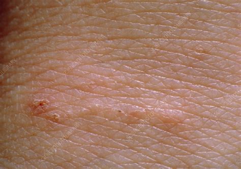 Scabies Rash On Skin Stock Image M2600040 Science Photo Library