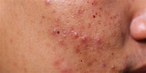 Pimples That Are Ok To Pop