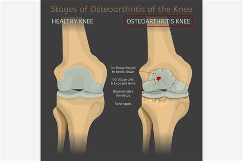 Stages Of Osteoarthritis Of The Knee Healthcare Illustrations