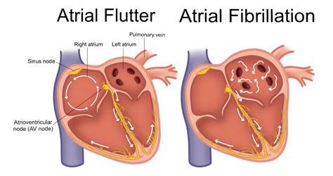 White Arrows In The Atria Represent The Macro Reentrant Circuit Of Atrial Flutter In The Right