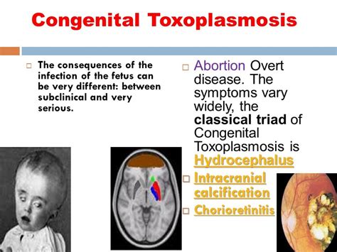 Toxoplasmosis Symptoms Causes Diagnosis Treatment Page Hot Sex Picture