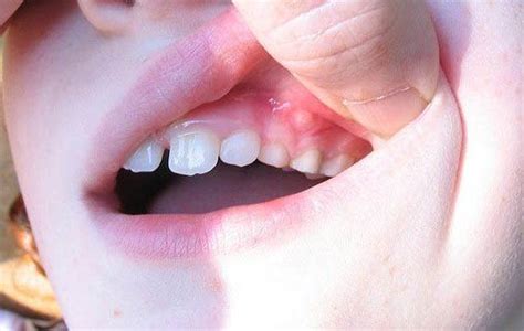 Canker Sores Likewise Called Mouth Ulcers Appear In The Mouth Or