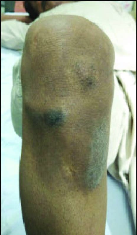 A Painful Nodule Over Anteromedial Aspect Of Knee Joint Marked Loss Of