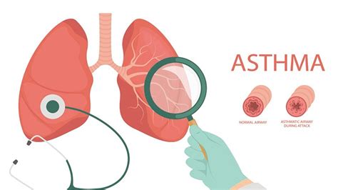 Common Treatments For Severe Asthma Entirely Health