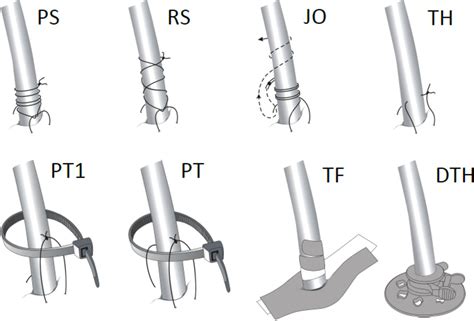 Intercostal Chest Drain Fixation Strength Comparison Of Techniques And