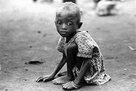 A Child Affected By The Biafran War In Nigeria In The Late 1960s 660
