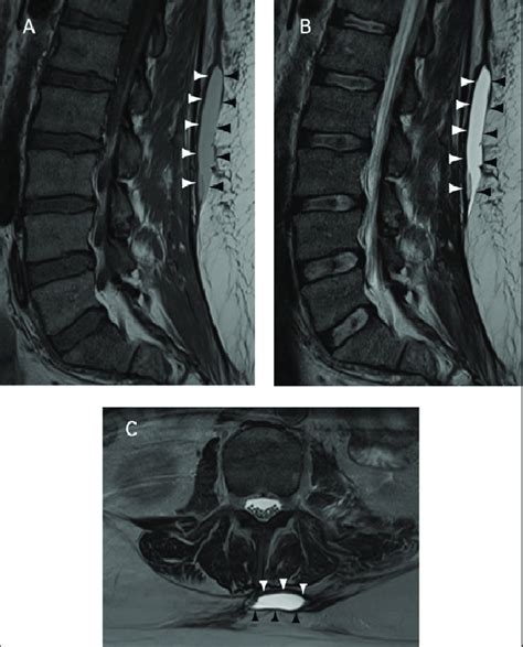 A 51 Year Old Man With Low Back Swelling Status Post Trauma Type Ii