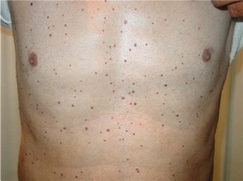 Chronic Cutaneous Lesions Induced By Sm Multiple Cherry Angiomas Over