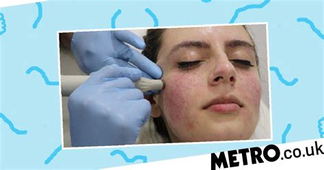 Is Getting A Vampire Facial Worth The Faff Metro News
