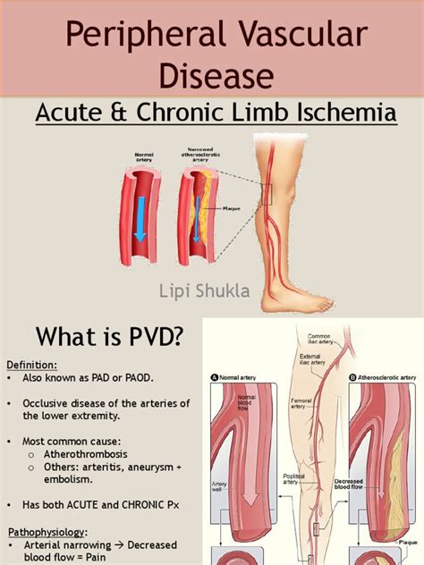Peripheral Vascular Disease Surgical Presentation Ischemia Angiology