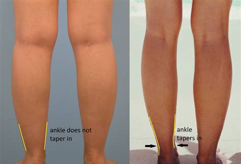 Dressing For Your Body Cankles Rfemalefashionadvice