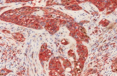 Scientists Find New Tumor Markers For The Prognosis Of Head And Neck Cancer