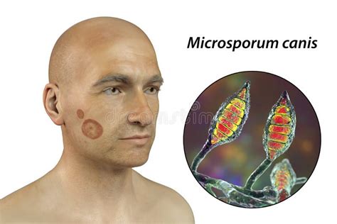 Microsporum Canis Fungal Infection 3d Illustration Stock Illustration