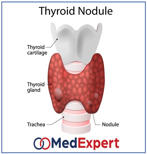 Thyroid Nodules Treatment Symptoms And Diagnostics Services Med Expert