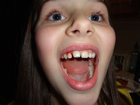How To Pull A Loose Tooth Out Without It Hurting How To Make A Loose Tooth Fal Erofound