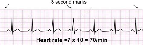 How To Calculate Heart Rate Rhythm Strip Haiper