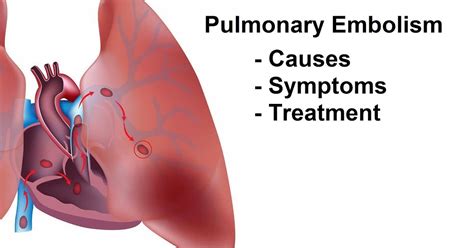 Z effective and iodine maps provide lung perfusion assessment. Pulmonary Embolism (Blood Clot In Lung) Causes, Signs And ...