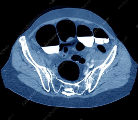Colon Cancer Ct Scan Stock Image C0479255 Science Photo Library