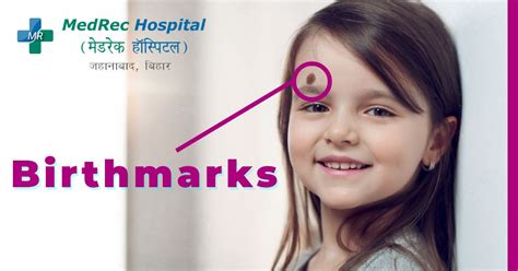 Birthmark Types Causes Complications And Treatment