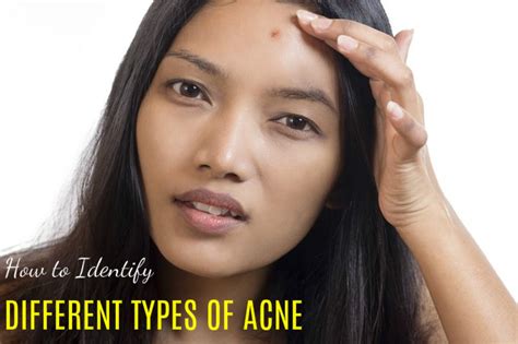 How To Identify Different Types Of Acne Best Guide Stylish Walks