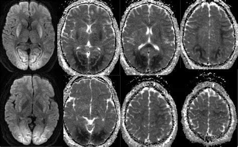 Anoxic Brain Injury