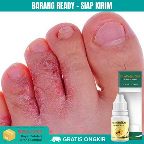 Jual Obat Kutu Air Obat Gatal Di Sela Jari Kaki Tangan Kaki Obat Kutu