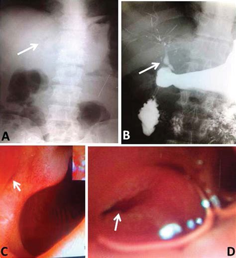 Spontaneous Choledochoduodenal Fistula With Tuberculous Duodenal