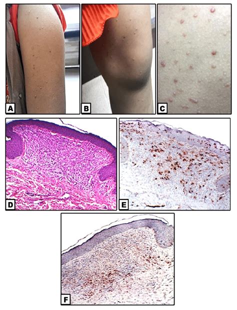 A 6 Year Old Female With Multiple Firm Dome Shaped Umbilicated Skin