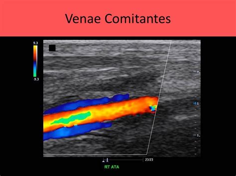 Ultrasound Registry Review Extremity Venous Vascular Ultrasound Ultrasound Sonography