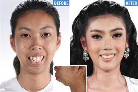 woman born with no chin undergoes incredible surgery to re build her face