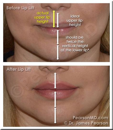 Lip Proportion Upper Lip Lower Lip The Vertical Height Of The Upper Lip Is Ideally One Half