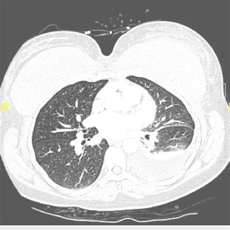 Computed Tomography Of The Chest Showing Left Pleural Effusion