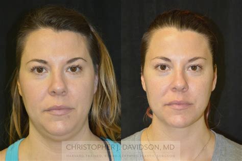 Liposuction For Boston And Wellesley Ma Dr Christopher J Davidson