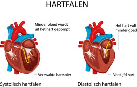 Hartziekten Hartfalen Patiënten Hartziekten Hartcentrum Ieper