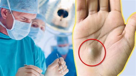 This Guy Found This Strange Lump On His Palm Then A Scan Revealed The