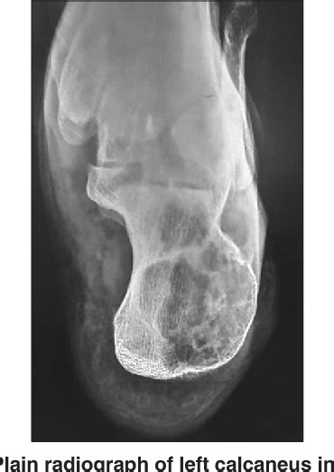 Figure 1 From Giant Cell Tumor Of The Calcaneus A Case Report