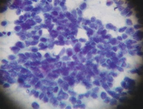 L'immunothérapie vise à mobiliser les défenses immunitaires du patient contre sa maladie. Pour le cancer du poumon à petites cellules, un médicament ...
