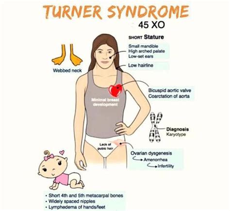 Turners Syndrome Causes Medizzy