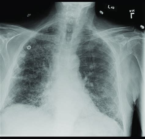 Radiograph Of Chest Showing Diffuse Reticular And Interstitial
