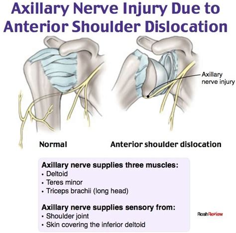 Axillary Nerve Injury Emergency Medicine Nursing School Survival