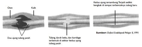 Osteoporosis umumnya tidak menimbulkan gejala pada tahap awal. Sistem Gerak pada Manusia - IPA Kelas 8