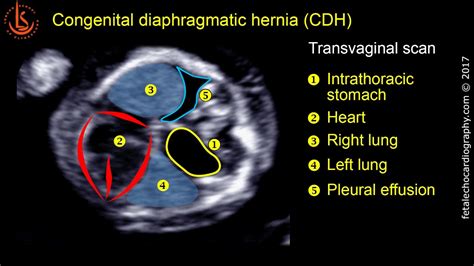 Fetal Echocardiography At 11 13 Weeks Congenital Diaphragmatic Hernia