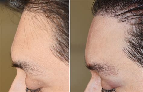 Plastic Surgery Case Study The Male Custom Forehead Implant For Upper