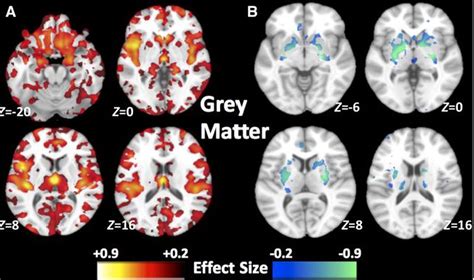 La Esquizofrenia Sin Huellas En El Cerebro Ciencia El PaÍs
