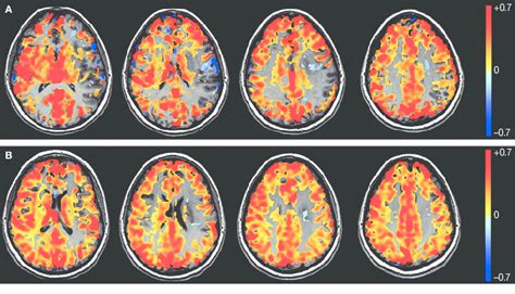 Whole Brain Bold Mri Cerebrovascular Reactivity Maps Obtained After