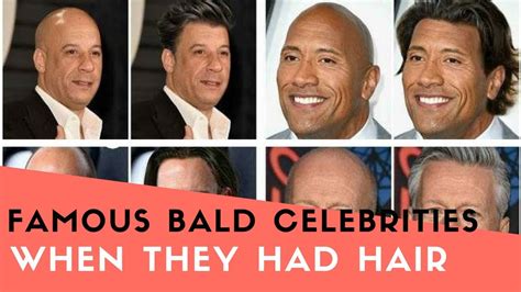 Famous Bald Celebrities When They Had Hair Youtube