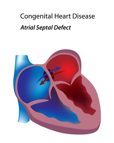 What is the normal structure of the heart. Comunicação Interatrial (CIA) - Hospital Sabará