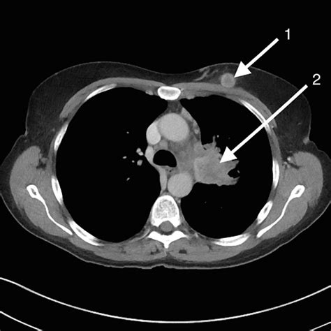 Breast Metastases From Primary Lung Cancer The Bmj