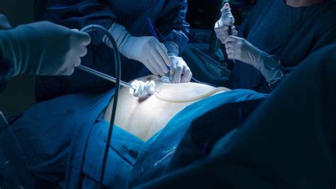 Antibiotics Can Replace Or Delay Surgery For Appendicitis In Adults