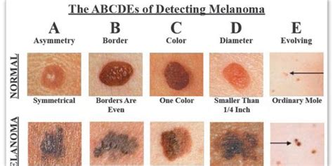 Skin Cancer Symptoms Causes And Treatment